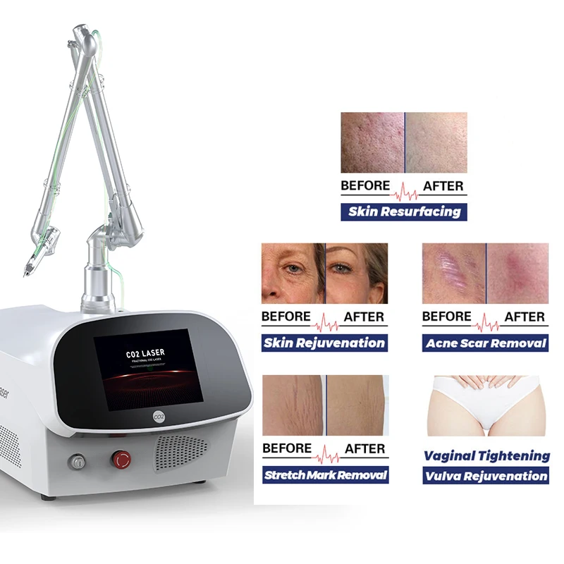 

portable laser co2 skin resurfacing scar removal stretch mark co2 fractional laser machine factory
