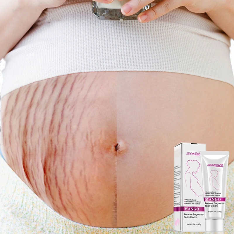 

HOT selling- Stretch Mark Cream Postpartum Deep Acne Scar Slack Line Abdomen Removal Mango Stretch Mark Cream