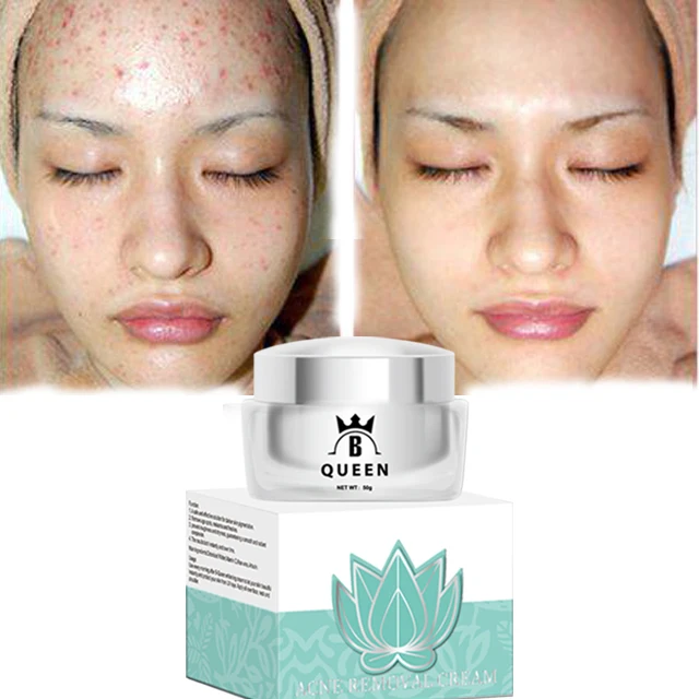 

Strong Effects Powerful Freckle Acne Treatment Cream Remove Melasma Acne Spots Pigment Skin Care