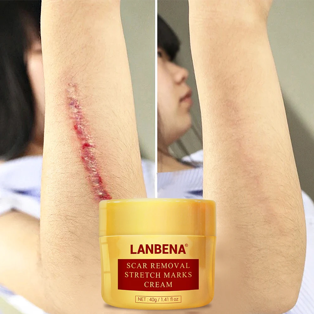 

OEM Custom private label LANBENA stretch mark acne scar removal cream pockmark repair mango remove pregnancy scars acne cream, As photo