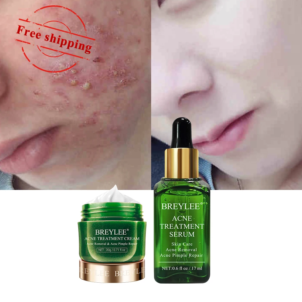 

BREYLEE tea tree acne spot treatment serum cream set free shipping
