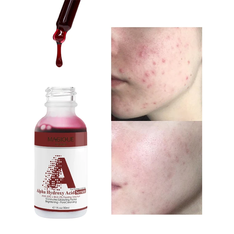 

AHA 30% and BHA 2% Peeling Solution Exfoliating Face Serum Anti Acne Skin Whitening Serum Chemical Peel for Face