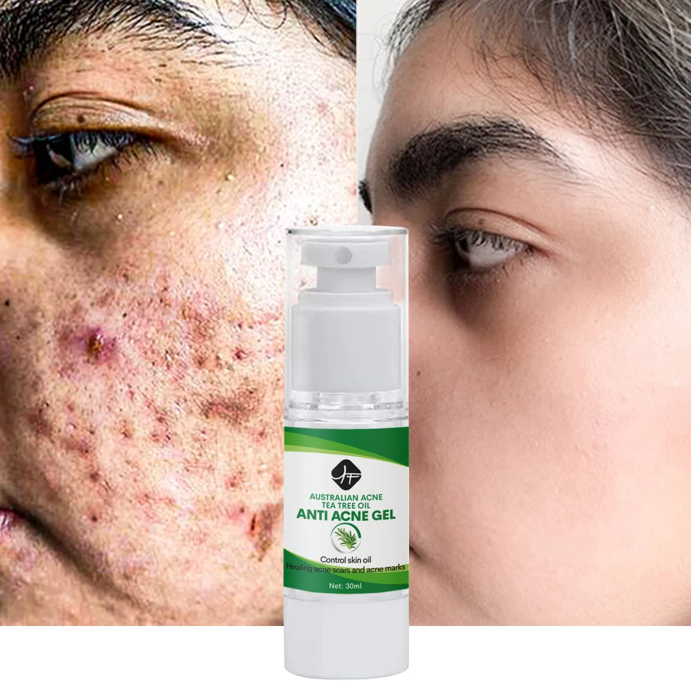 

OEM/ODM Private Label tea tree pimples dark spot remover Scar deep cleaning face skin care treatment anti acne gel cream