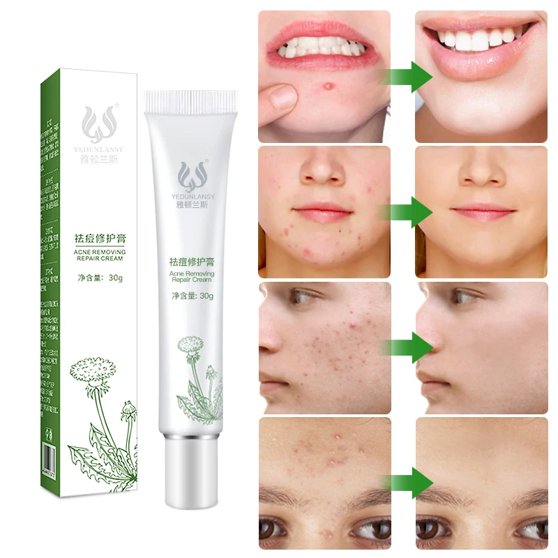 

private label 100% effective acne treatment cream A variety of herbal plant extracts Gentle and quickly acne-aid cream