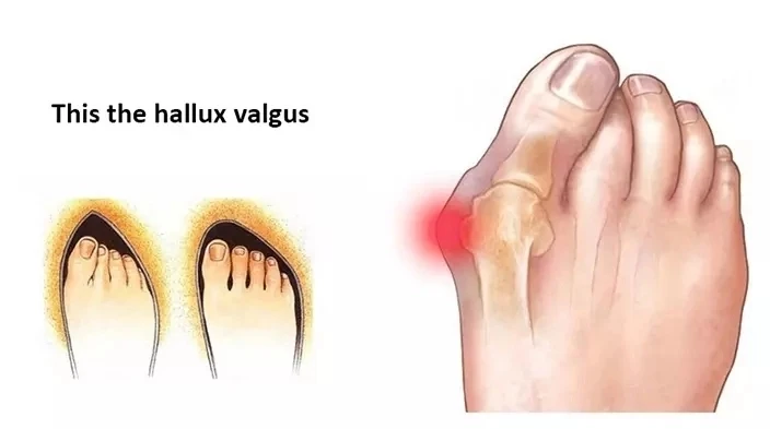 toe corrector (6).jpg