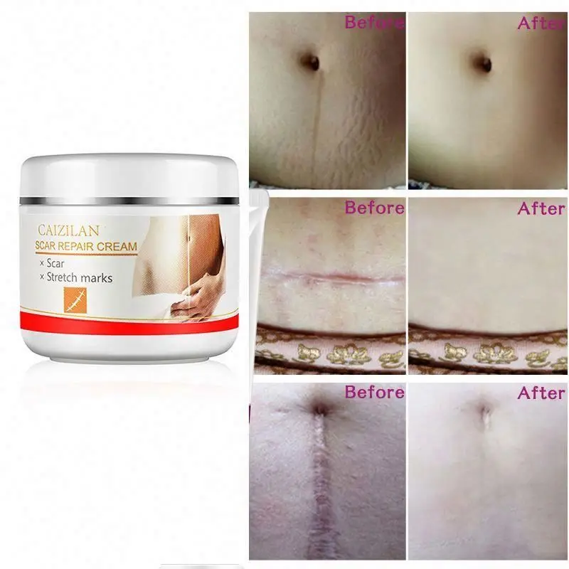 

new cheaper Top 10 selling in alibaba market approved free samples stretch marks removal gel