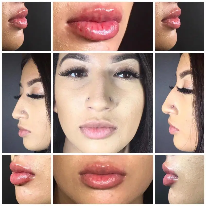 
hot sale hyaluronic acid injection Hyaluronic Acid Dermal Fillers 