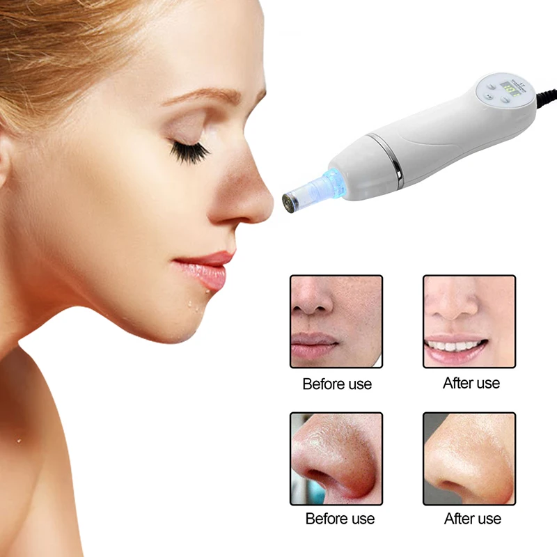

Hot on Amazon item Blackhead Remover Vacuum Blackhead Removal Skin Care Diamond Peeling Blackhead Remover, White