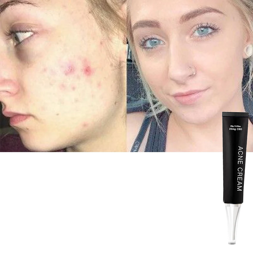 

PLYH Face skin care oem beauty products anti aging acne treatment oil control cream