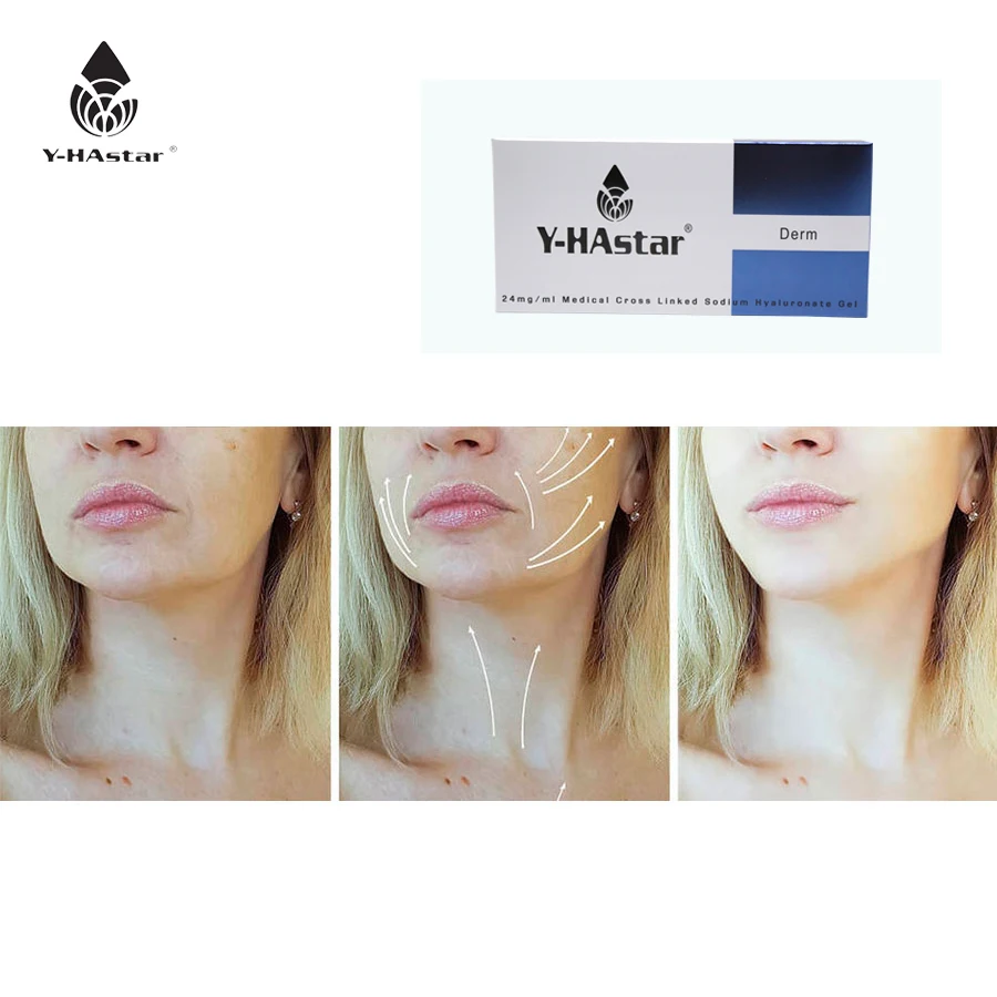 

hyaluronic acid dermal filler facial injection for shaping facial contours 2ml, Transparent