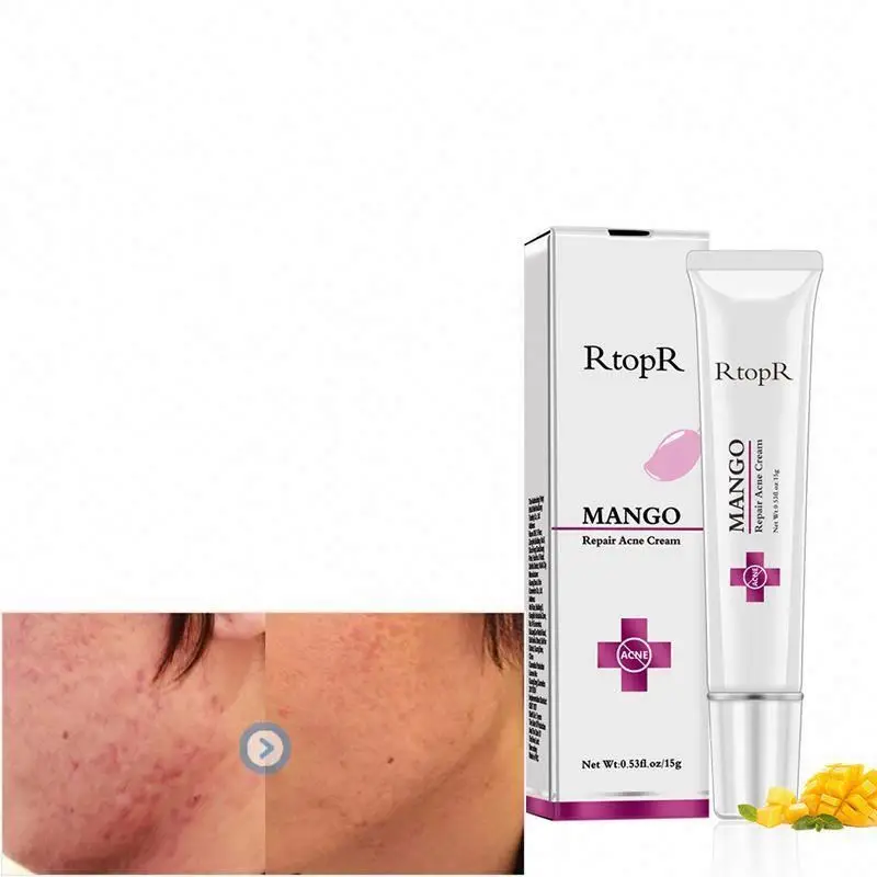 

Private label skin care ice-cream acne treatment cream for Women