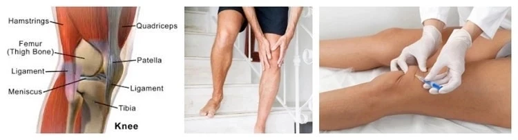 Можно в коленный сустав делать уколы. Флексотрон Соло укол в сустав. Флексотрон кросс укол в сустав. Суставная жидкость в коленном суставе уколы. Внутрисуставная жидкость коленного сустава.