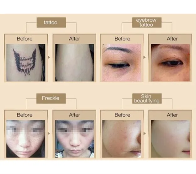 2021 New Arrival Vertical  Picosecond  Acne Pock Mark Wrinkle Removal Beauty Device with best feedback