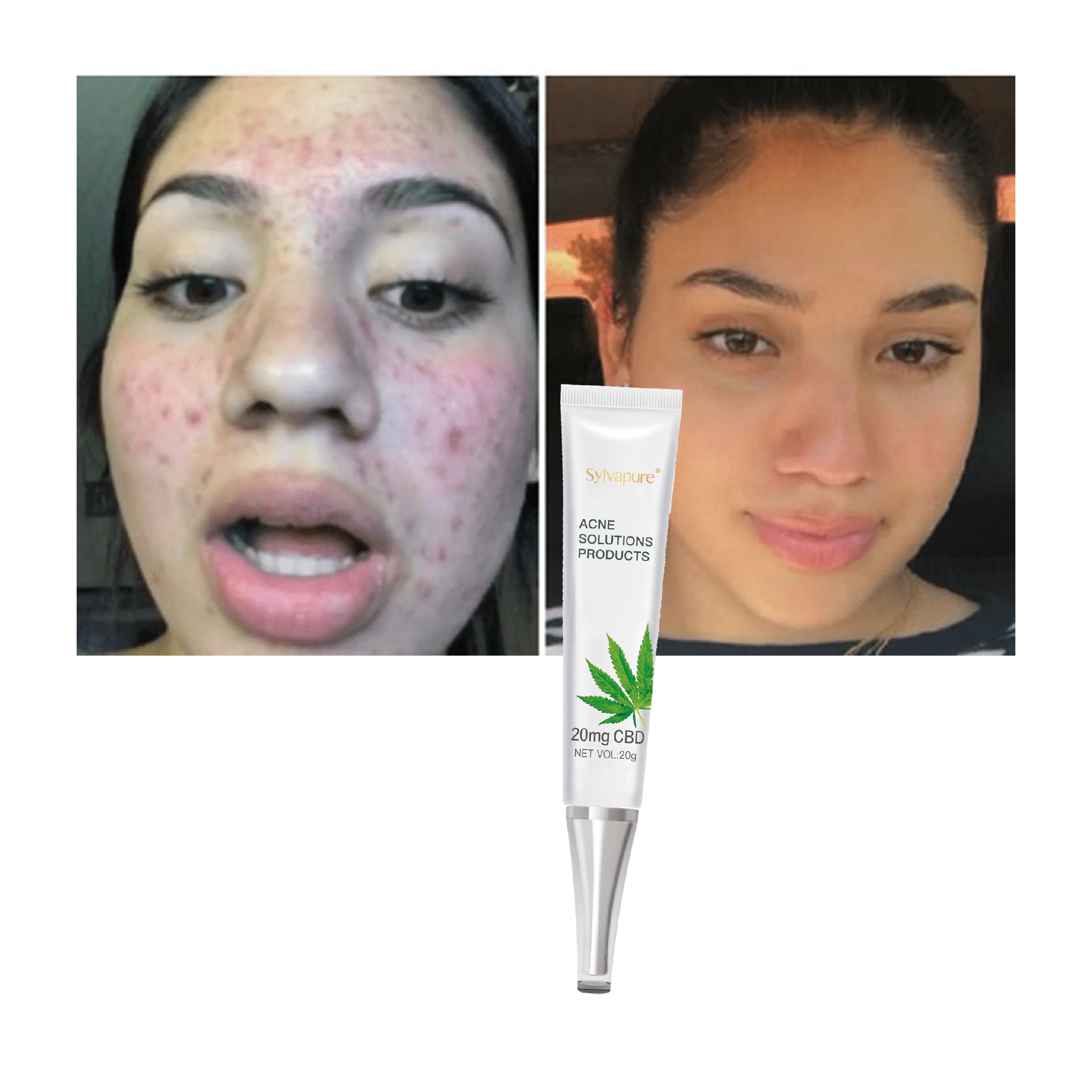 

OEM CBD Hemp Cream Marks Spots Acne Treatment Acne Aid Scar Blackhead Cream Pimple Removal Lighting Face Cream