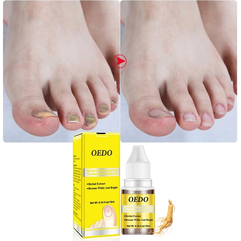 

Wholesale Nail Foot Care Effective Natural Treatment For Fungal Nail