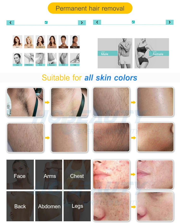 laser hair removal permanent price