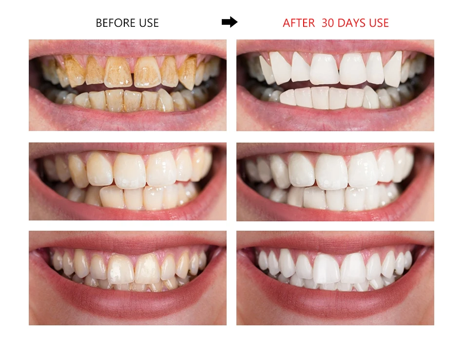 calculus teeth before and after