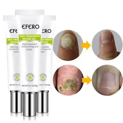 

Efero Nail Treatment Repair Gel Feet Care Anti Infection Onychomycosis Fungal Nail Treatment Cream
