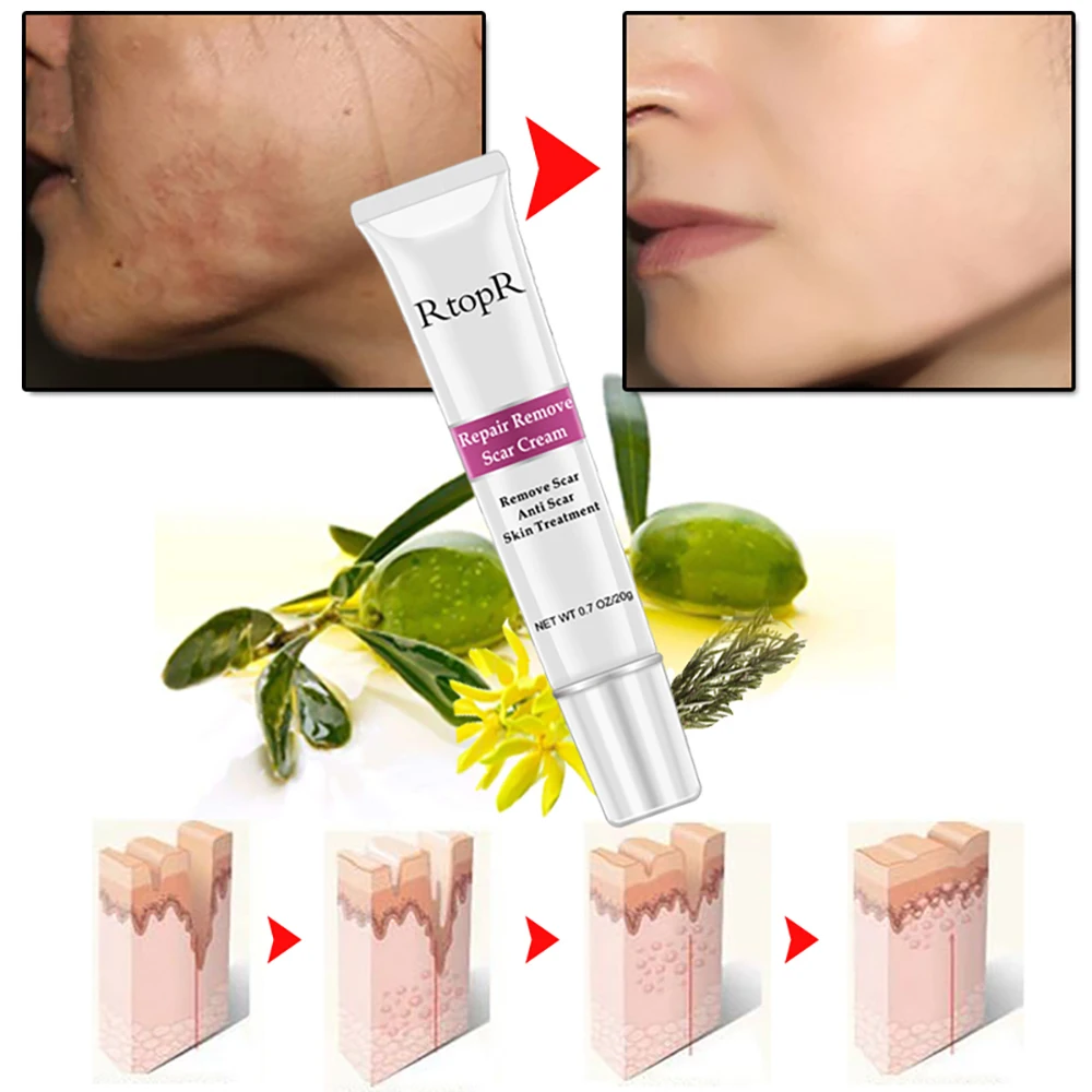 Natural Plant Anti Scar Skin Repair Deep Scar Removal Cream Buy Scar