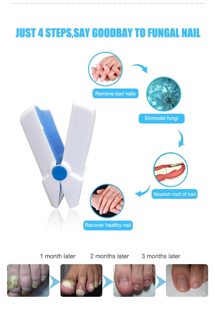 Podology Toenail Fungus Treatment 905nm 470nm Blue Led Light Nails