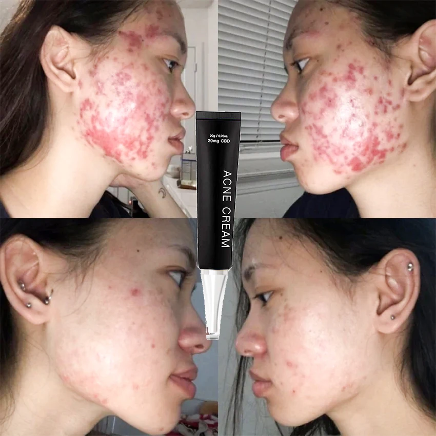 

Private Label Vitamin C CBD acne scars treatment Anti Aging Wrinkle Acne Dark Black Skin Bleaching Whitening Face Cream