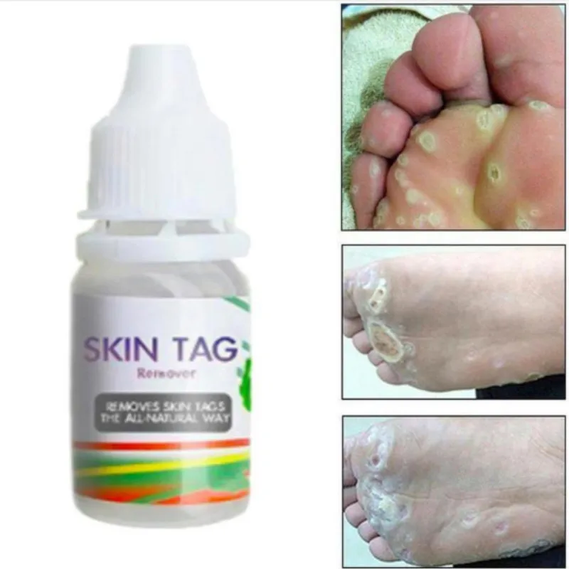 Как выглядит шипица после азота Dissolvant Des Étiquettes Pour La Peau,Outil Médical Pour Enlever Les Points Noi