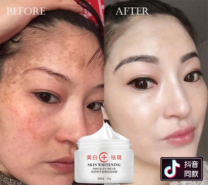 

Pimples Dark Spot Corrector Remover Cream Face Black Spot And Pigment Removal Cream