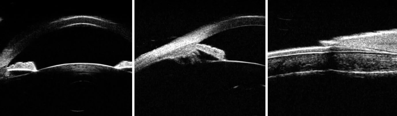 Угол передней камеры. Убм переднего отрезка глаза. Синдром пигментной дисперсии. Ультразвуковая биомикроскопия. Убм переднего отрезка глаза.