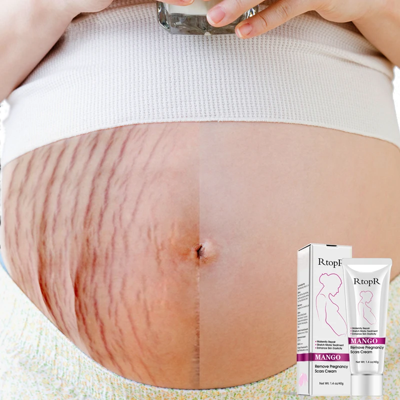 

RtopR Enhance Skin Elasticity Maternity Repair Stretch Marks Treatment Cream