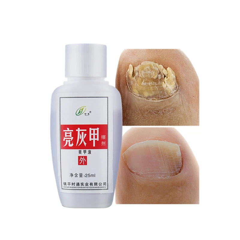 

Wholesale onychomycosis oral excilor nail fungus treatment for toe and finger nail fungal infections #1 natural cure