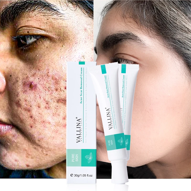 

VALLINA anti acne gel with glycerin product acne scar removal cream