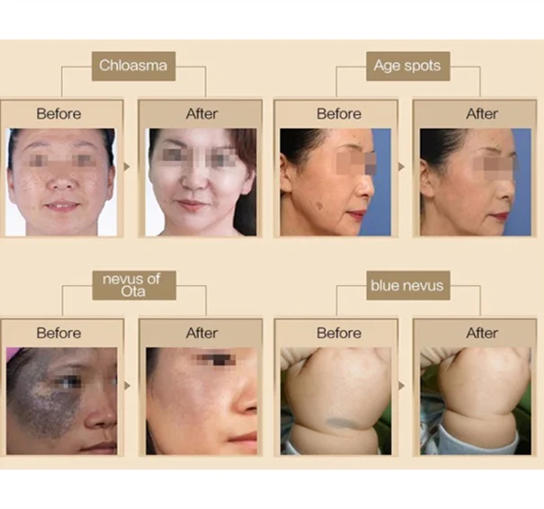 2021 New Arrival Vertical  Picosecond  Acne Pock Mark Wrinkle Removal Beauty Device with best feedback