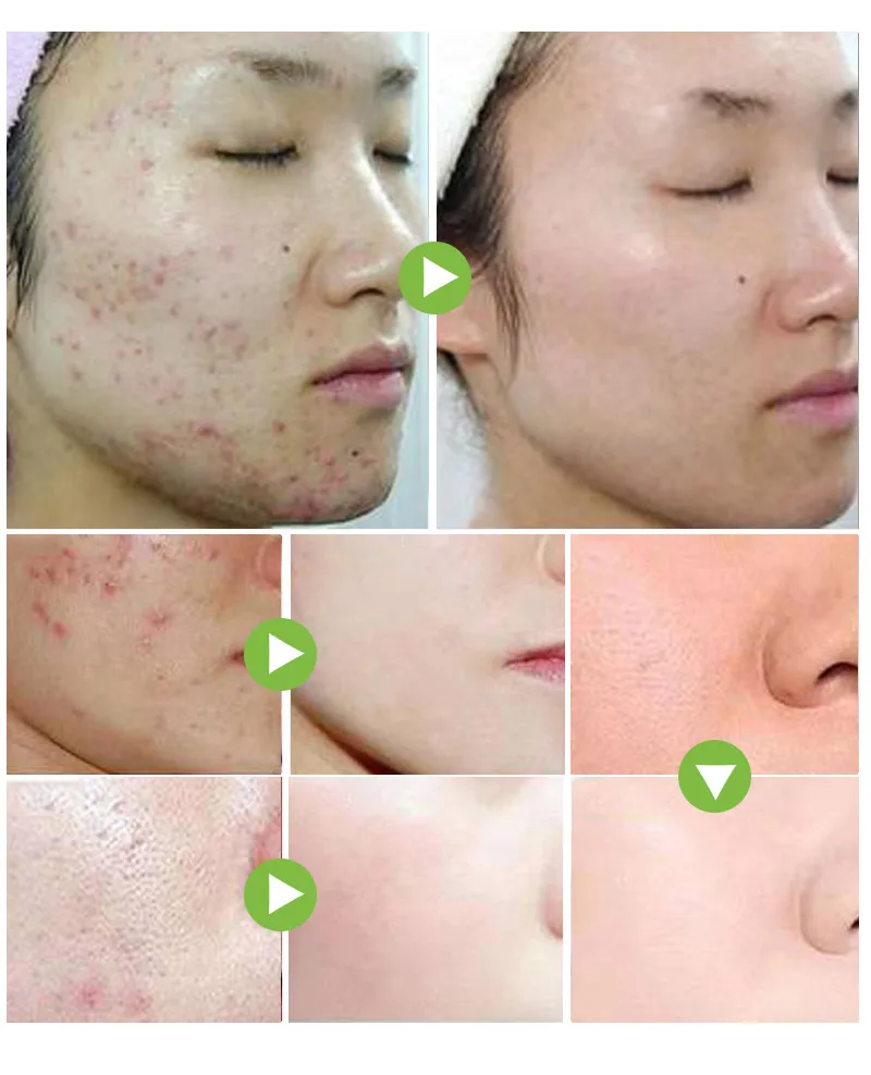 茶树祛痘霜消除痘印控制油脂分泌净化毛孔黑头细腻保湿面部