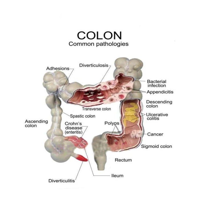 pvc human anatomy colon pathology model for medical teaching and