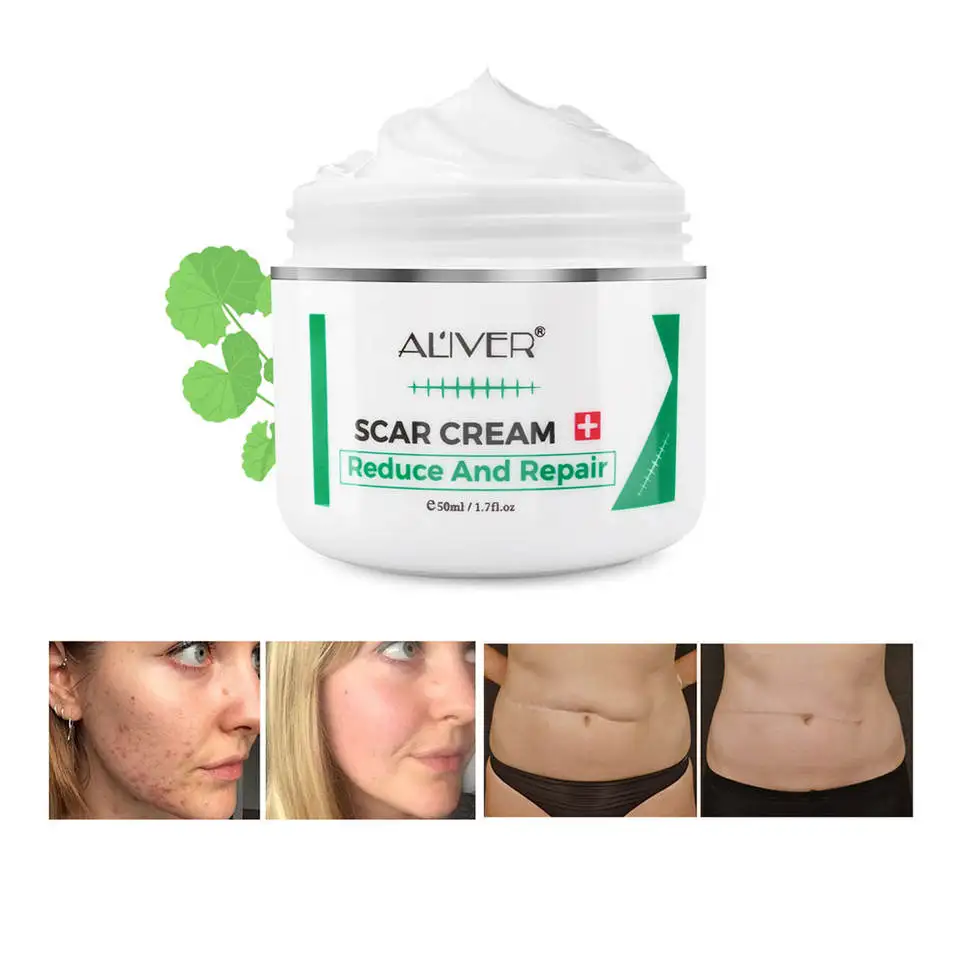 

ALIVER Natural Herbal Acne Pimple Stretch Marks Treatment Skin Repairing Facial Cream Good Effective Scar Removal Cream
