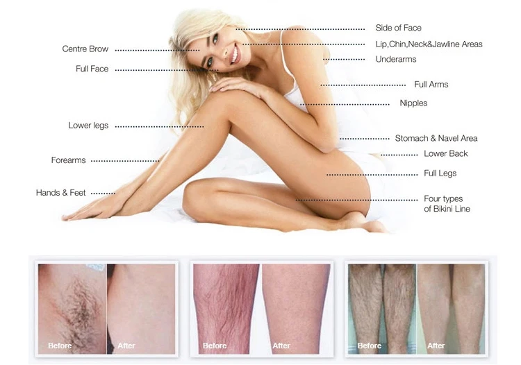 755 808 1064 diode laser