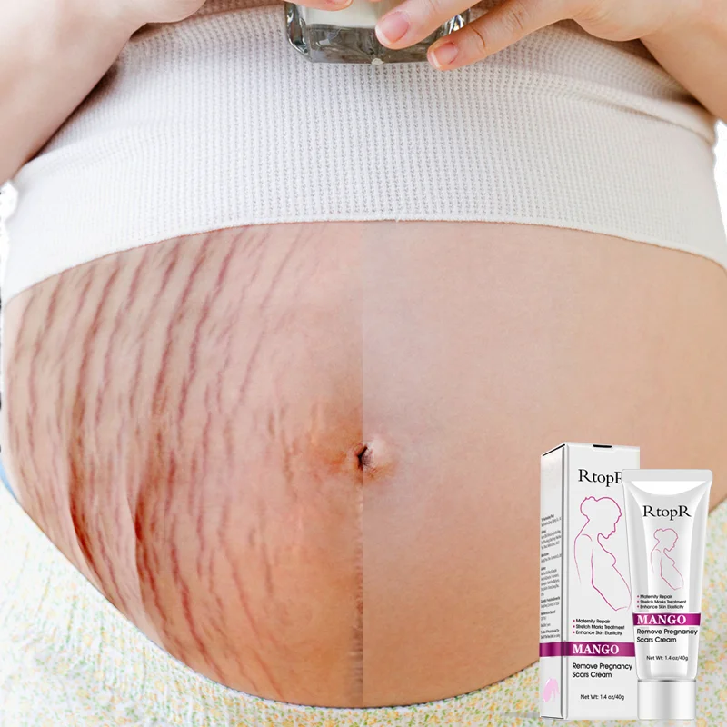 

Factory Wholesale Amazon Hot Selling Repair Remove Pregnancy Scars Treatment Stretch Marks Removal Cream, White
