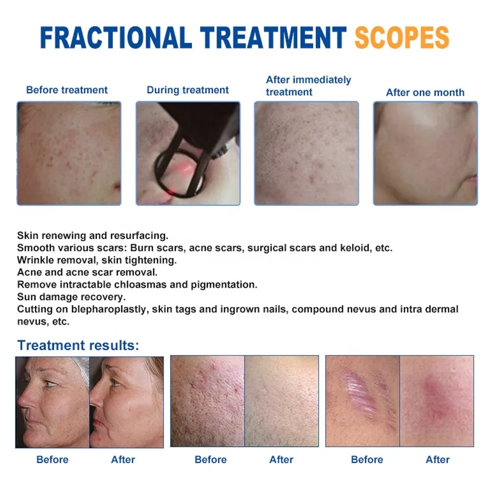 
Factory Direct Sales co2 plus fractional laser co2 laser: snj-1000u fractional co2 laser fractional seaheart 