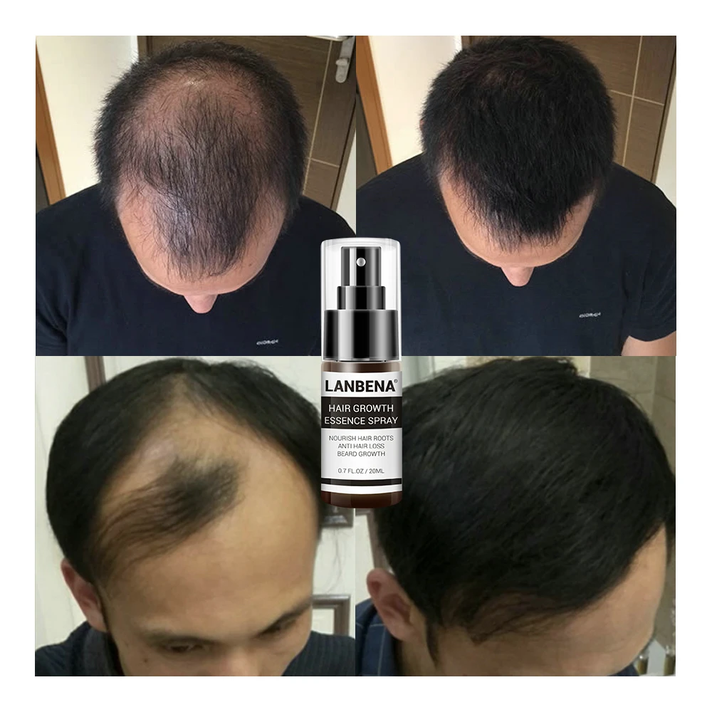 

GINGER EXTRACT Hair Care Hair Loss Fleece Flower Root LANBENA Hair Growth Oil 20ml, Black