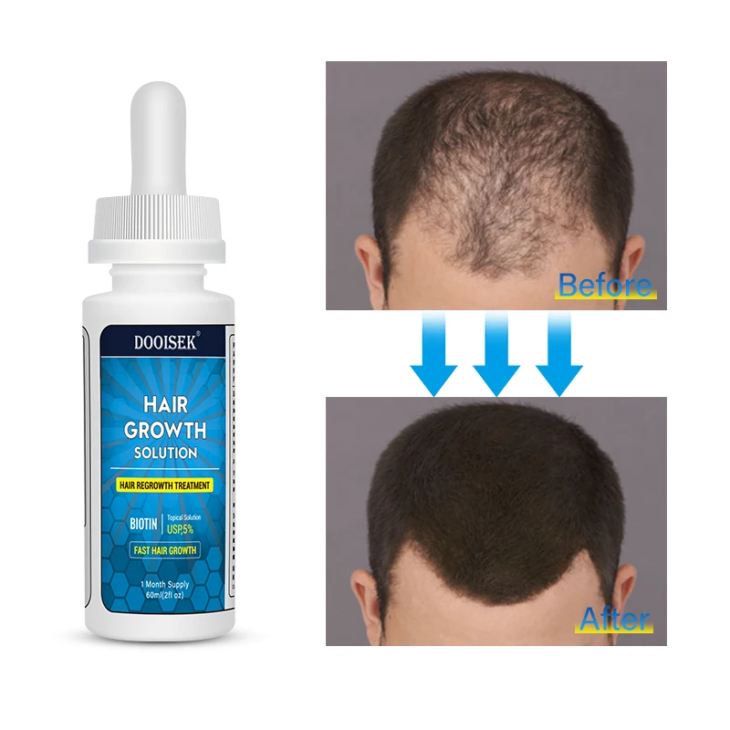 

60ml hot sell anti hair loss treatment hair growth oil Biotin hair care Serum