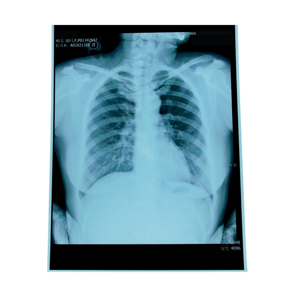 
Factory price Mammography Film/Radiography Film/Breast Medical X ray film 