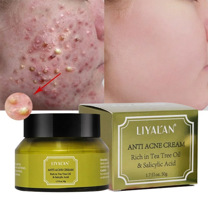 

Hot Sale Skin Care Acne treatment Scar Remove Acne Pimples Organic Herbal Anti Acne Face Cream