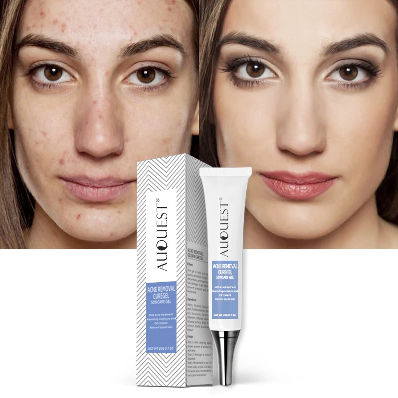 

100%Pore herbal ingredients aloe vera anti acne cream cream anti acne scar moisturizer skin gel, White color