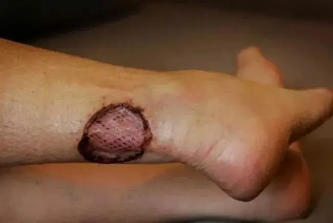 wound dressing 01.jpeg