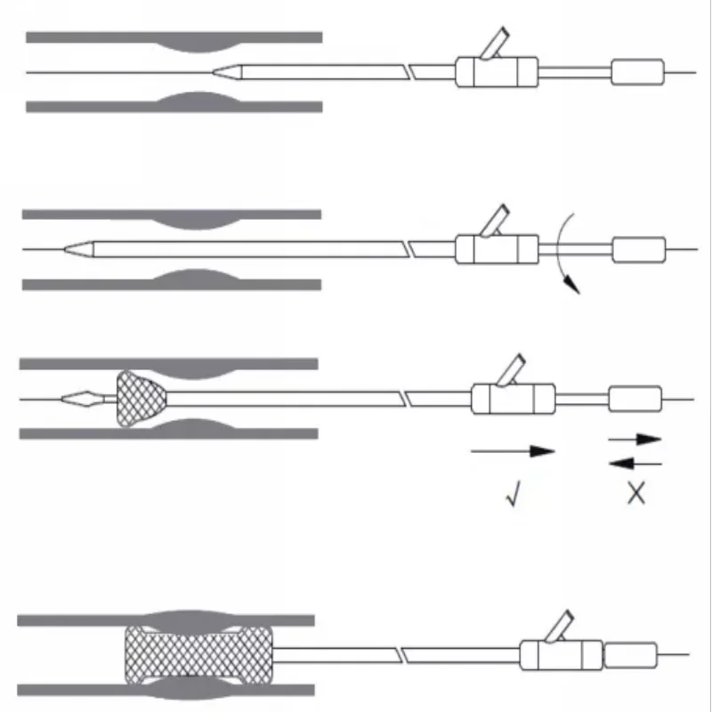 Nitinol Selfexpandable High Radial Force Surgical Rectal Stent Buy