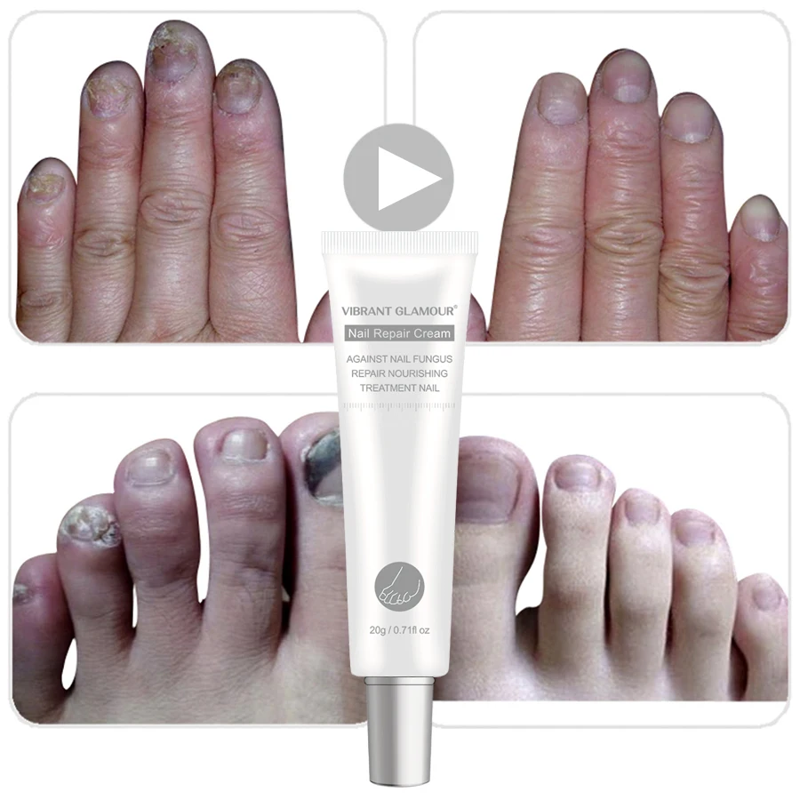 

Snake oil fungus onychomycosis repair nail treatment cream
