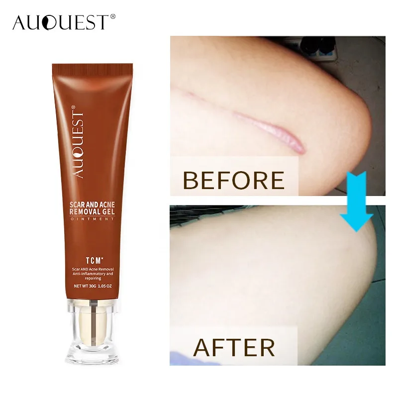 

Wholesale Factory Price Hot selling 100% Natural Facial body Acne Scar Removal Cream