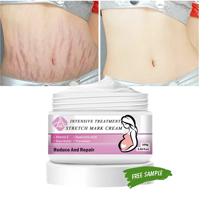 

AH High Effect Maternity Scar Stretch Marks Removal Cream Remove Pregnancy Stretch Mark Cream