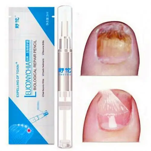 

Anti Fungal Nail Treatment Liquid Toe Nail Finger Fungus Onychomycosis Repair