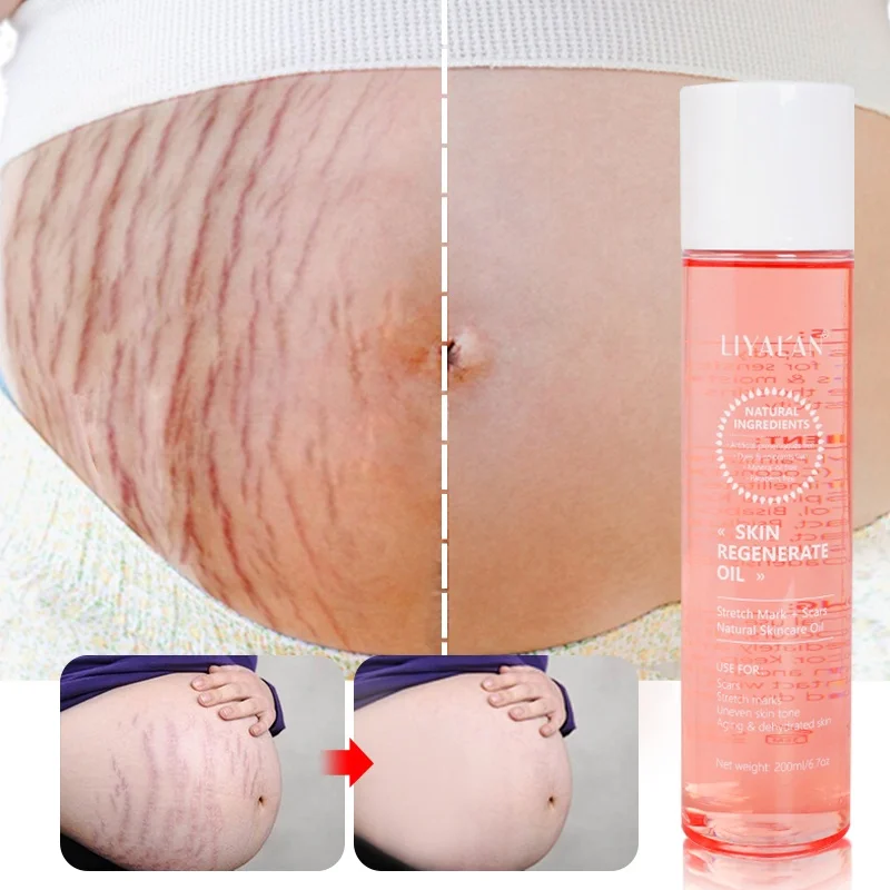 

Essential Oil New Natural Organic Skincare Message Oil Anti Stretch Mark Anti Scar Body Oil